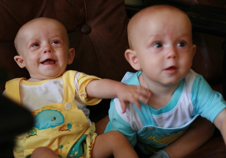 Щастя, коли діти усміхаються: одного з двійнят успішно прооперували за пуповинною програмою. Фото з сайту hemafund.com